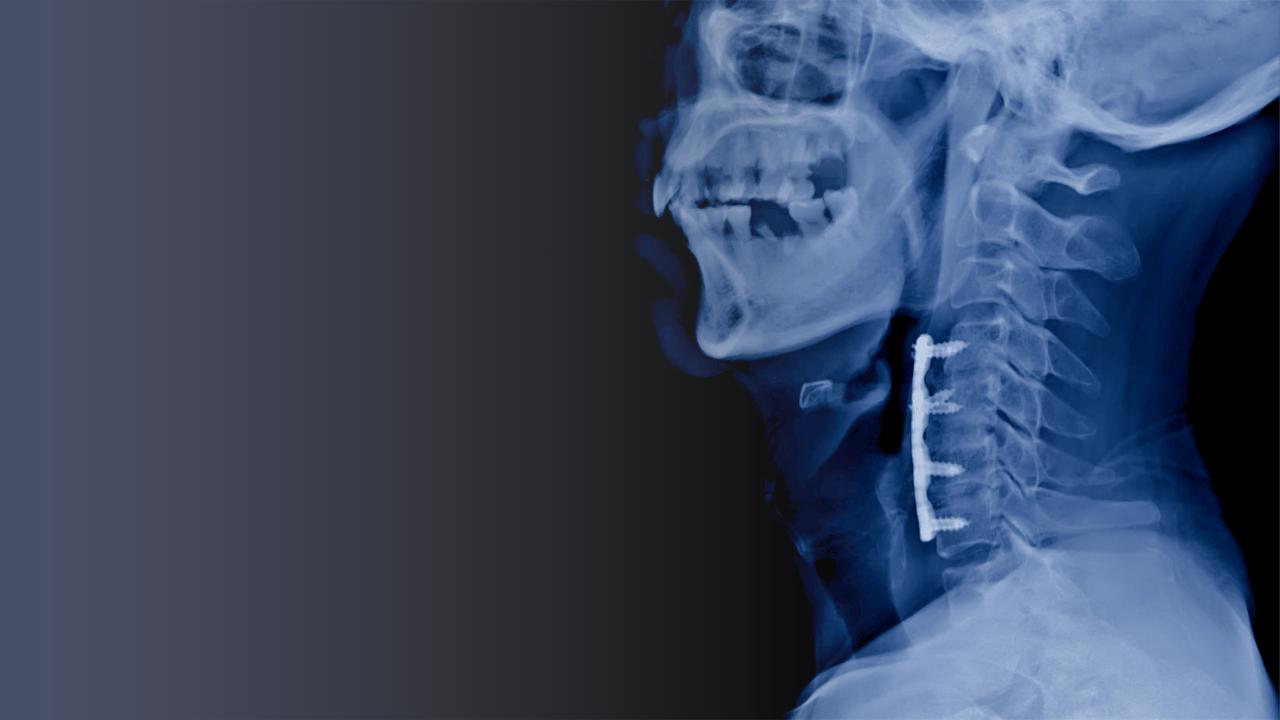 Medical Massage as a Conservative Strategy to Avoid Cervical Fusion